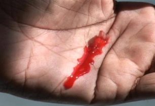 Co nejlépe zastaví krvácení? Celox! + VIDEO