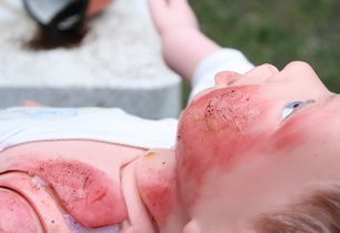 Mýtus o první pomoci — Z kávy s mlékem dítě mít popáleniny nebude