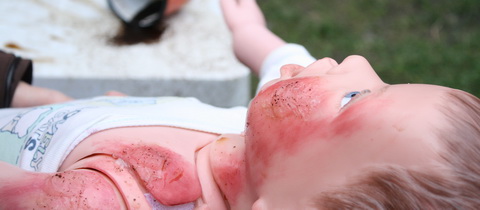 Mýtus o první pomoci — Z kávy s mlékem dítě mít popáleniny nebude