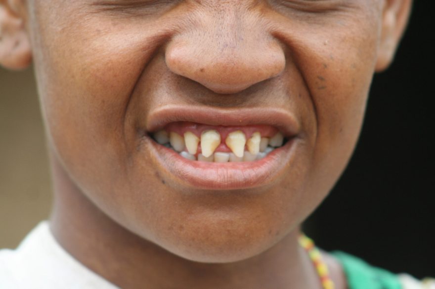 Vybroušené dívčí zuby