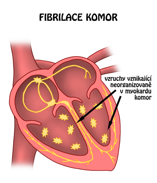 Fibrilace srdečních komor