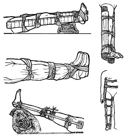 Improvizované dlahování dolních končetin