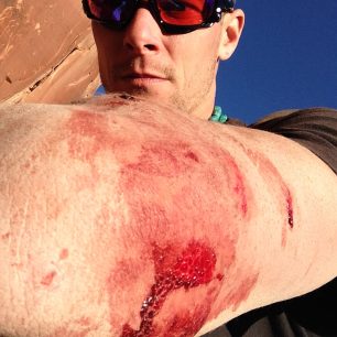 Na povrchová zranění jsou horolezci zvyklí