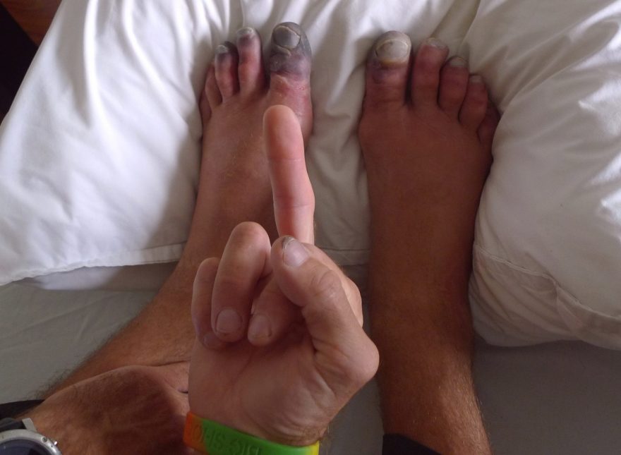 Omrzlé prsty se budou léčit hodně dlouho, ale Mára má jasno:)